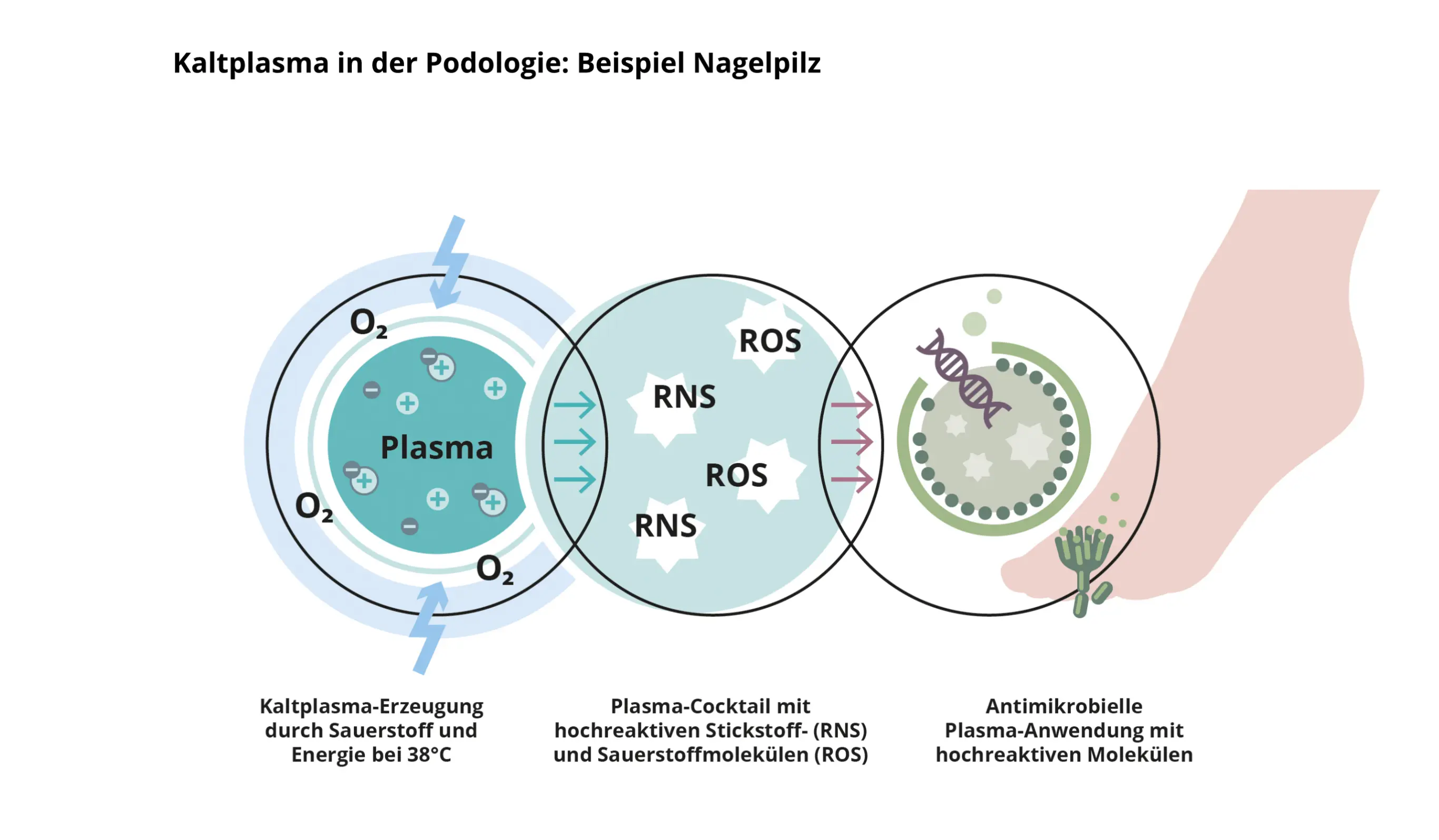 Kaltplasma Behandlung in Aktion